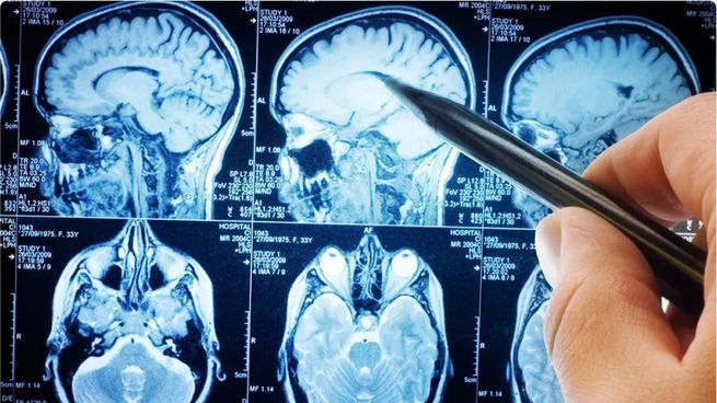  Cerebro: un medicamento contra el Alzheimer frena un 35% el avance de la enfermedad
 