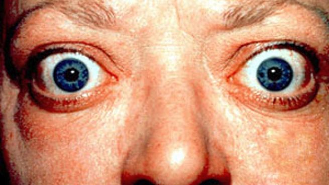  El 20% de los pacientes con hipertiroidismo puede necesitar una cirugía ocular
 