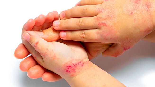  Dermatitis atópica, la enfermedad en la piel que no deja dormir a los niños
 