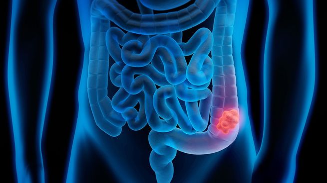  Instalarán un colon inflable gigante en Ciudad para concientizar sobre este tipo de cáncer
 