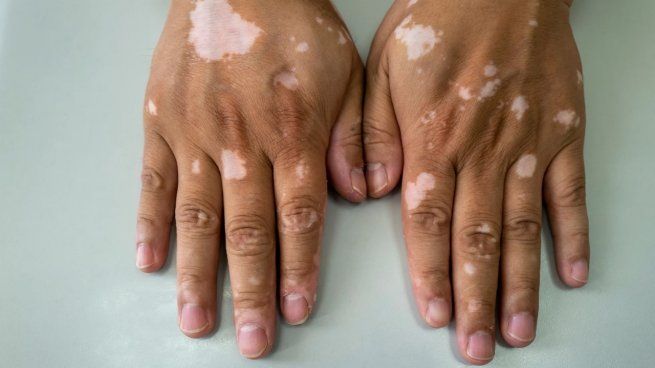  Día Mundial del Vitiligo: a quiénes afecta, cuál es el origen y cómo se trata
 